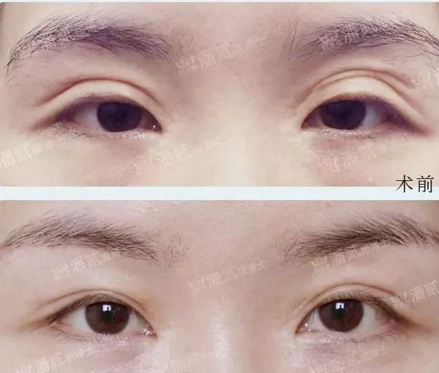 眼窝凹陷的原因是什么（以下眼窝凹陷的5种情况）(6)