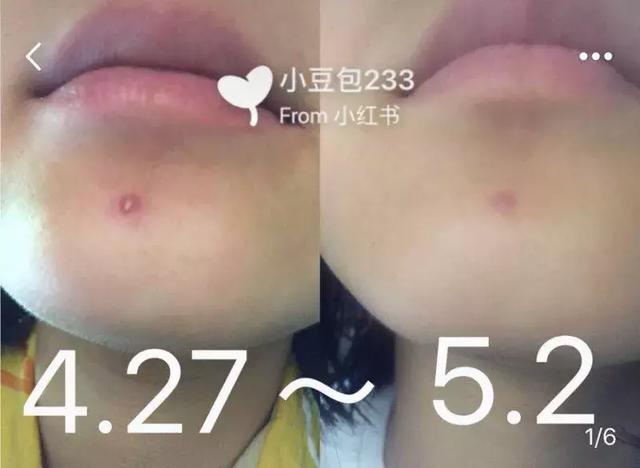 祛痘印痘疤最有用的产品(亲测上百款祛痘产品)(9)