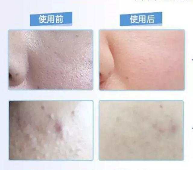 祛痘印痘疤最有用的产品(亲测上百款祛痘产品)(40)