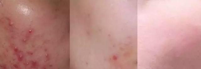 祛痘印痘疤最有用的产品(亲测上百款祛痘产品)(2)