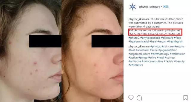 祛痘印痘疤最有用的产品(亲测上百款祛痘产品)(15)