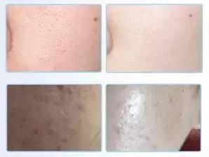 祛痘印痘疤最有用的产品(亲测上百款祛痘产品)(41)