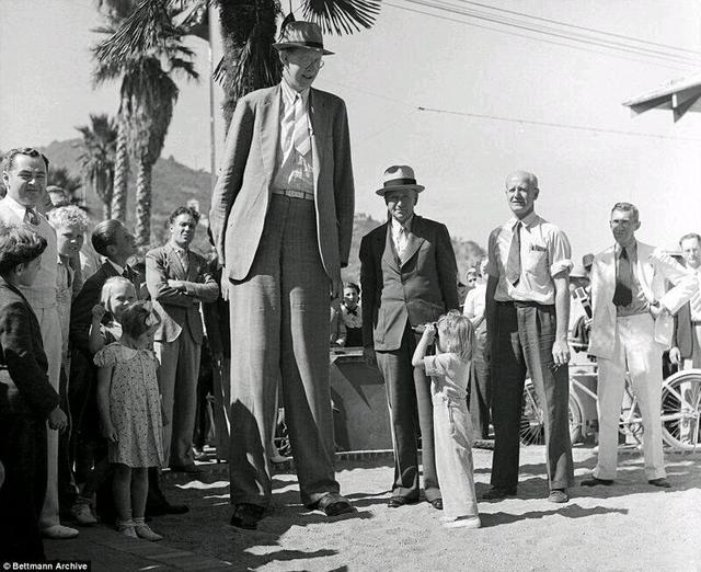 人类最大的骨头(10个拥有罕见身体特征的人类)(10)