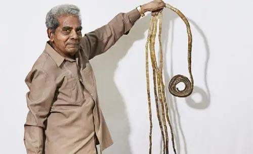 人类最大的骨头(10个拥有罕见身体特征的人类)(13)