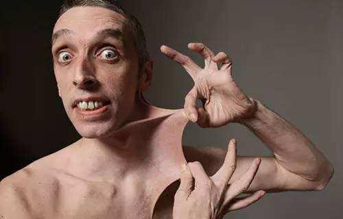 人类最大的骨头(10个拥有罕见身体特征的人类)(7)