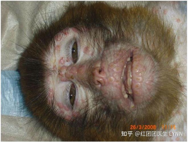 普通人该如何应对猴痘（个人如何预防猴痘）