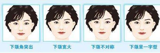 下颌角肥大怎么自我改善(下颌角肥大的情况怎么处理)(1)