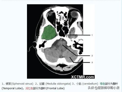 ​「高清CT图」头颅CT色彩分叶解剖示意图