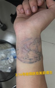 洗纹身会留疤吗?