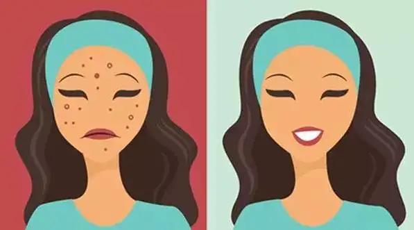 非常严重的痘坑怎么治(看这一篇就够了)(2)