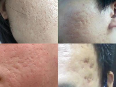 ​非常严重的痘坑怎么治（看这一篇就够了）