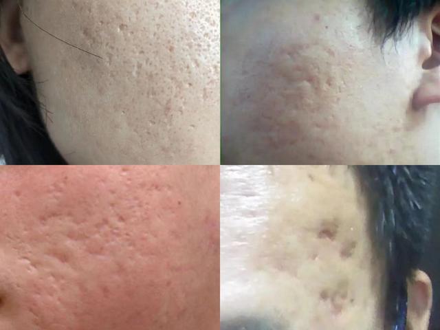 非常严重的痘坑怎么治(看这一篇就够了)(1)