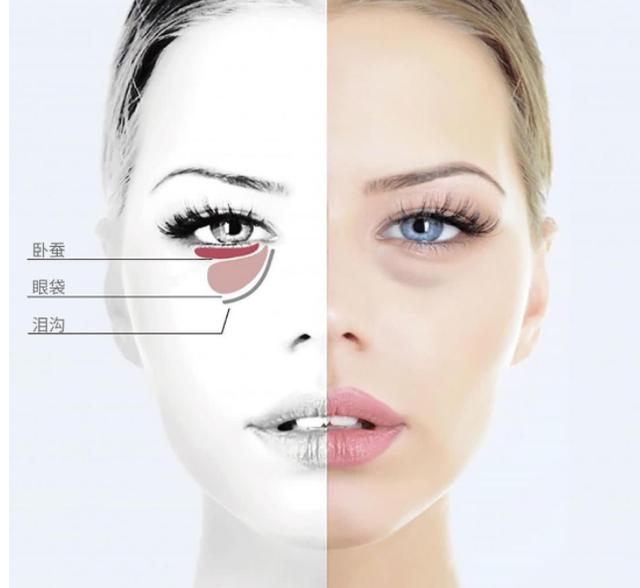 下眼袋松弛怎么办简单去眼袋方法(女人长眼袋太显老)(5)