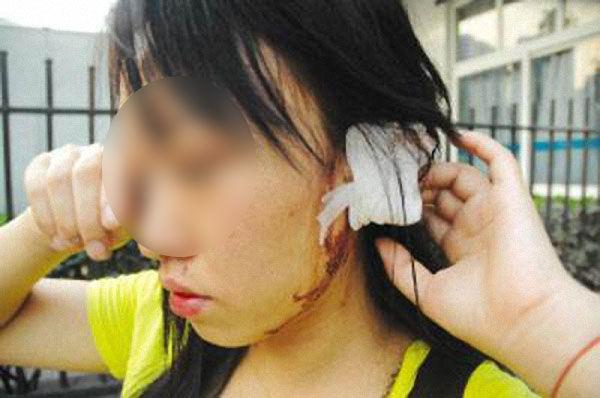 23岁女子与男友激吻太用力，导致耳膜破裂化脓，让人哭笑不得