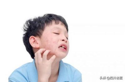 ​痄腮的症状照片 痄腮的症状是什么