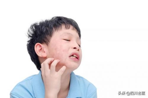 痄腮的症状照片  痄腮的症状是什么-第1张图片-