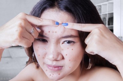 ​脸部痘痘位置代表什么？一文让你看懂