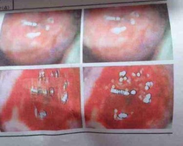 ​宫颈糜烂2度严重吗用不用治疗 这三点危害要注意