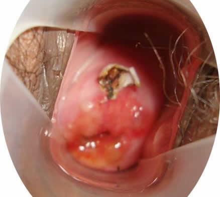 宫颈糜烂2度严重吗用不用治疗 这三点危害要注意