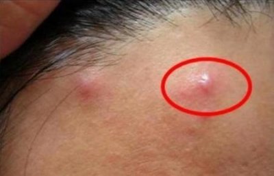 ​痘痘一直红肿(痘痘肌的图片)